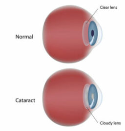 Cataract Diagram