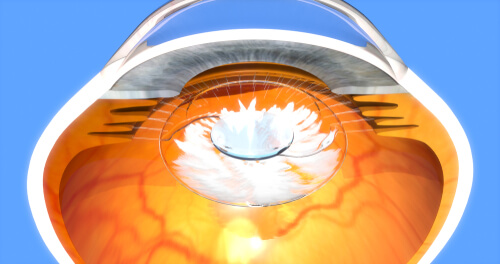 YAG Laser Capsulotomy diagram