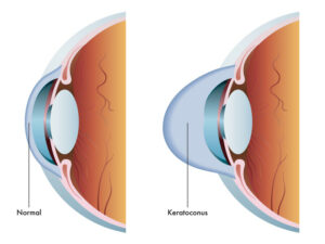 Normal cornea shown with cornea with Keratoconus