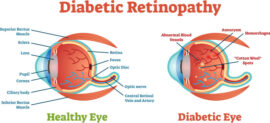 Diabetic Eye