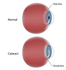 Cataract Chart