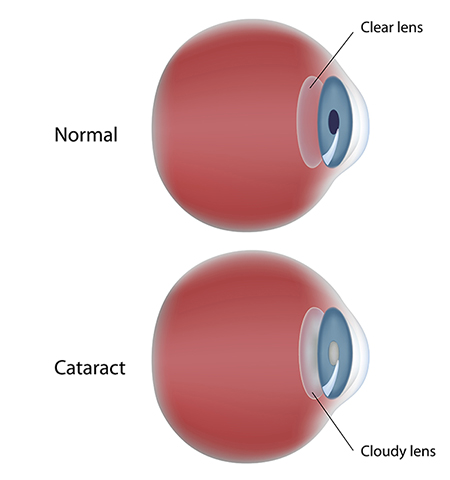 Cataract Chart