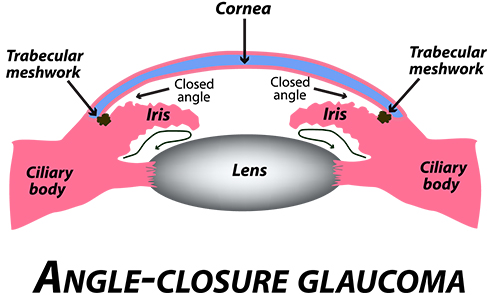 Closed Angle Glaucoma