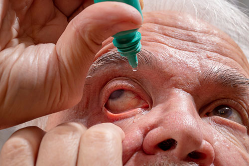 Glaucoma patient Eye drops