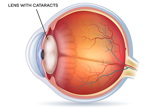 Lens with Cataracts diagram