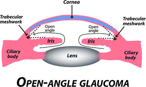 Open Angle Glaucoma