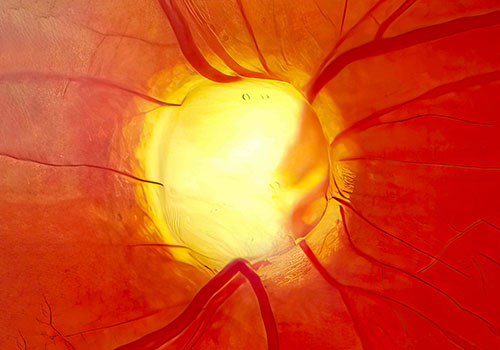 Optic nerve in advanced glaucoma disease.